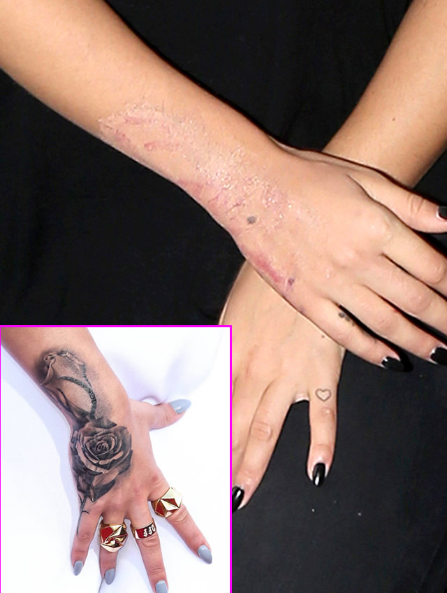 Rita Ora Changes Her Mind Yet Again, Gets Rose Hand Tattoo Removed-  PopStarTats